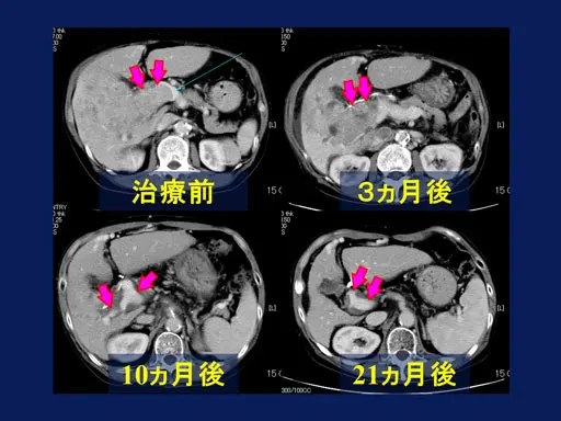 肝細胞癌・体幹部定位放射線治療例