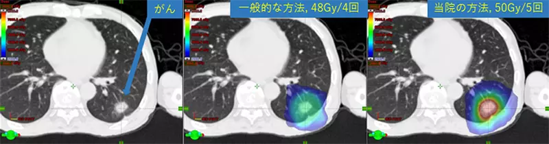 同じ肺がんに対して一般的なSBRTと当院の提唱したSBRT方法で照射した場合の体の中の放射線量の分布
