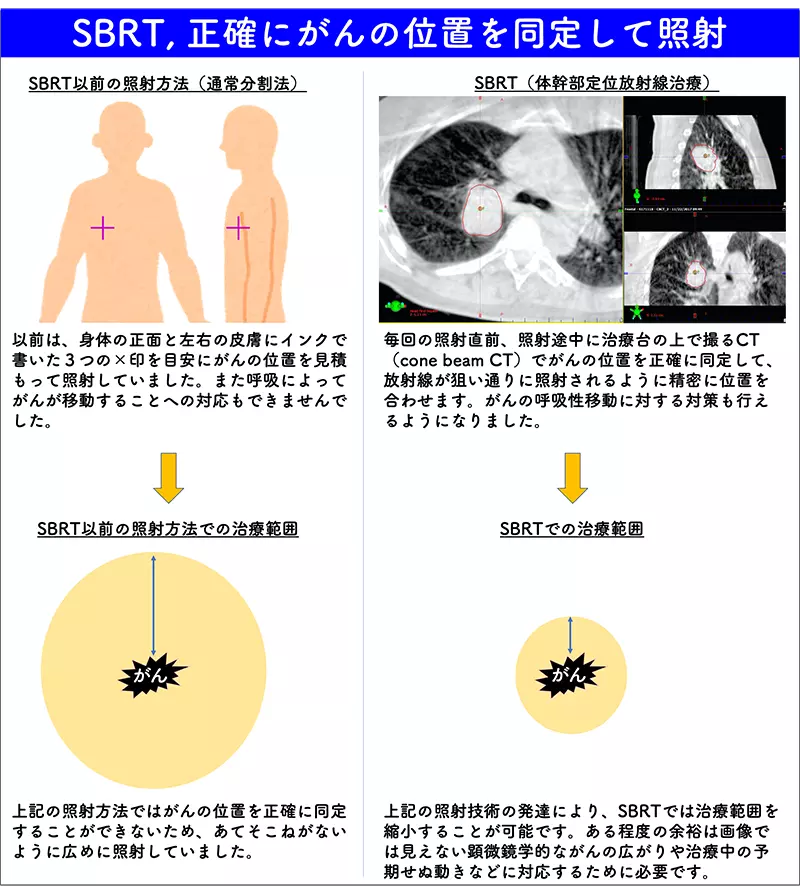 SBRT(体幹部定位放射線治療）とそれまでの照射方法（通常分割法）の比較。がん病巣の同定、照射範囲
