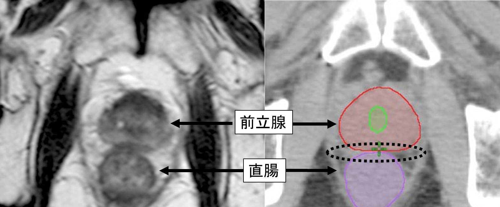 勃起不全脊髄損傷