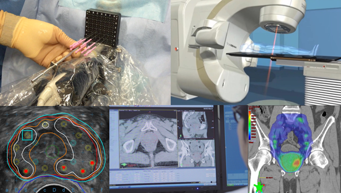 当院の前立腺がんへの放射線治療