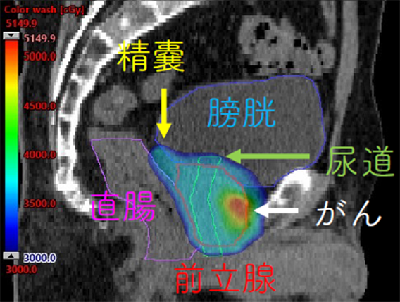 SBRTにおける線量分布